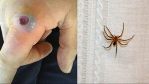 Qué araña pica y hace ampolla: Identificación y Tratamiento