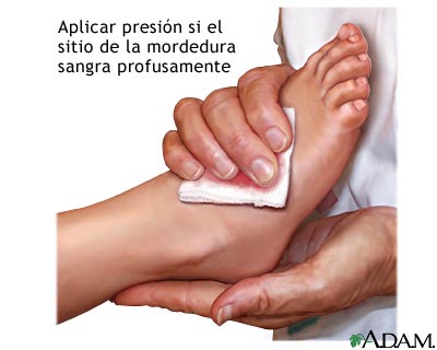Persona aplicando primeros auxilios a una picadura