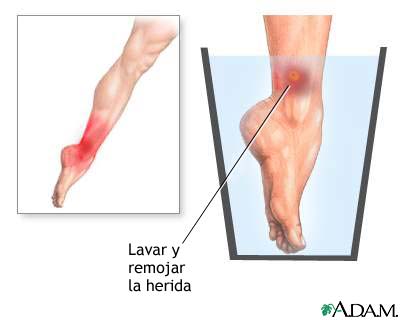 Picadura de medusa en la piel humana