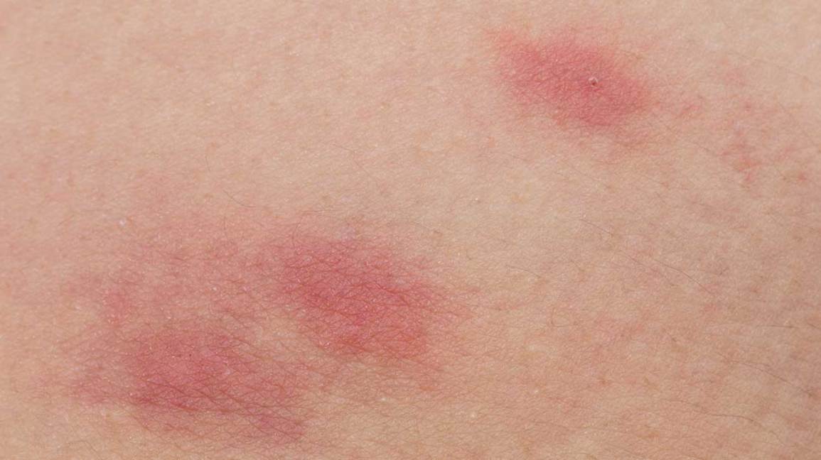 Inflamación y enrojecimiento en la piel picada
