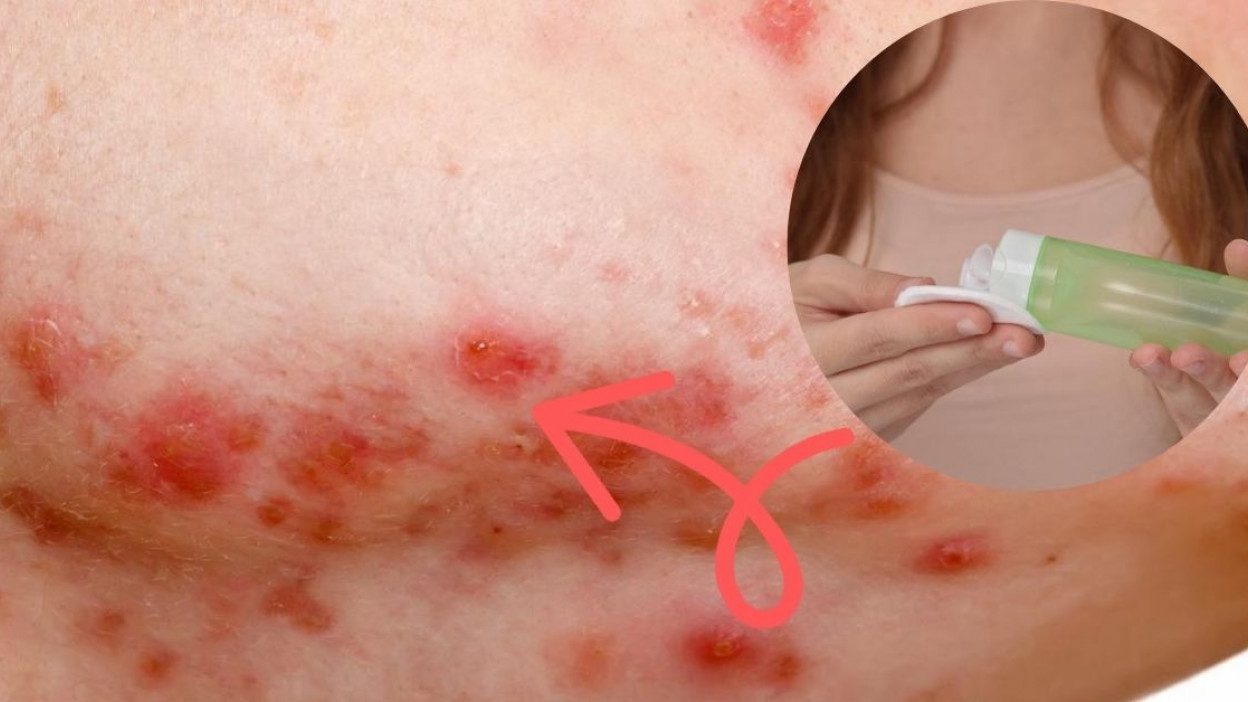 Piel irritada por uso de ácido salicílico
