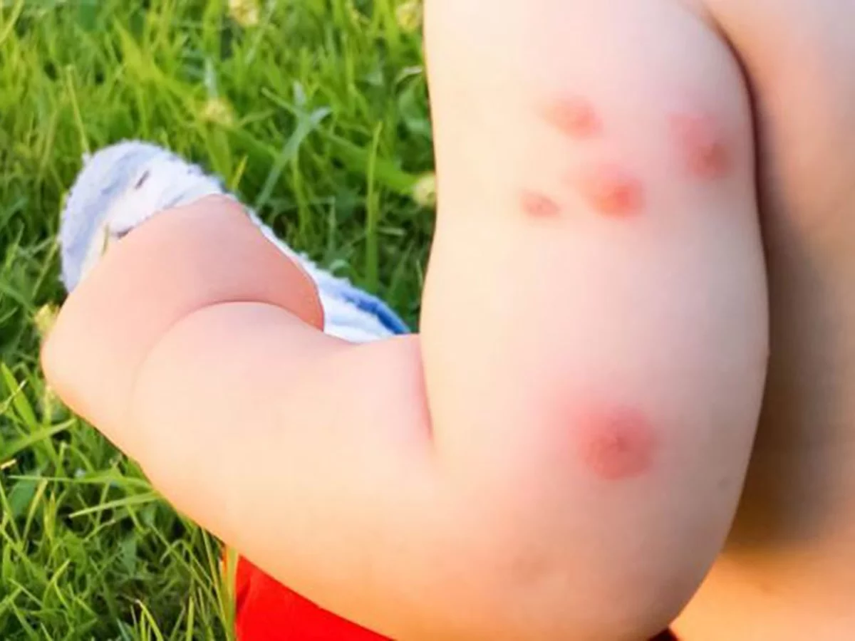 Picadura de mosquito en brazo de niño