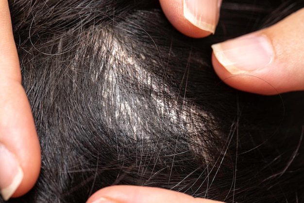 Mujer revisando cabello en busca de piojos